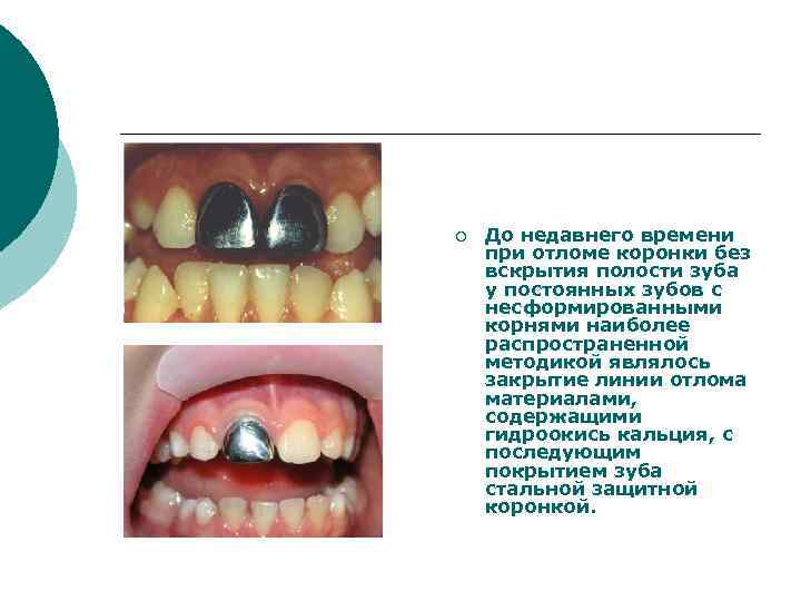 ¡ До недавнего времени при отломе коронки без вскрытия полости зуба у постоянных зубов