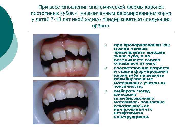 При восстановлении анатомической формы коронок постоянных зубов с неоконченным формированием корня у детей 7