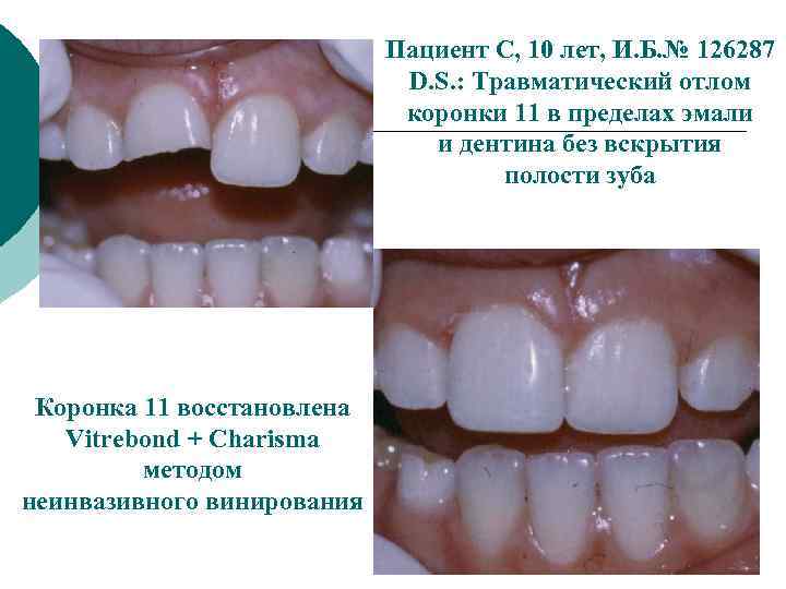 Пациент С, 10 лет, И. Б. № 126287 D. S. : Травматический отлом коронки