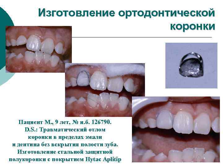 Изготовление ортодонтической коронки Пациент М. , 9 лет, № и. б. 126790. D. S.