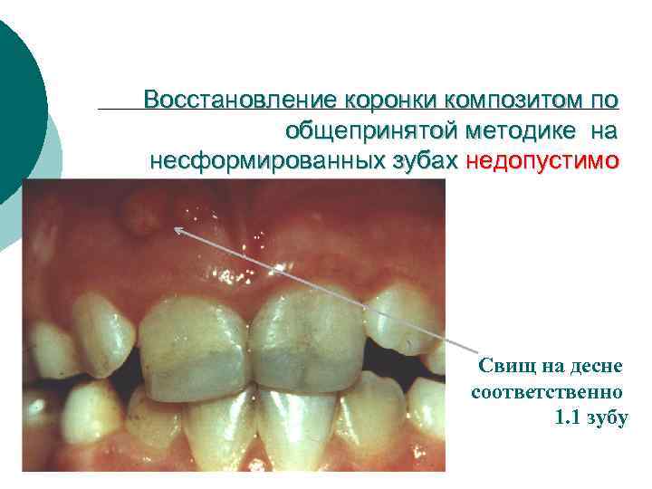 Восстановление коронки композитом по общепринятой методике на несформированных зубах недопустимо Свищ на десне соответственно