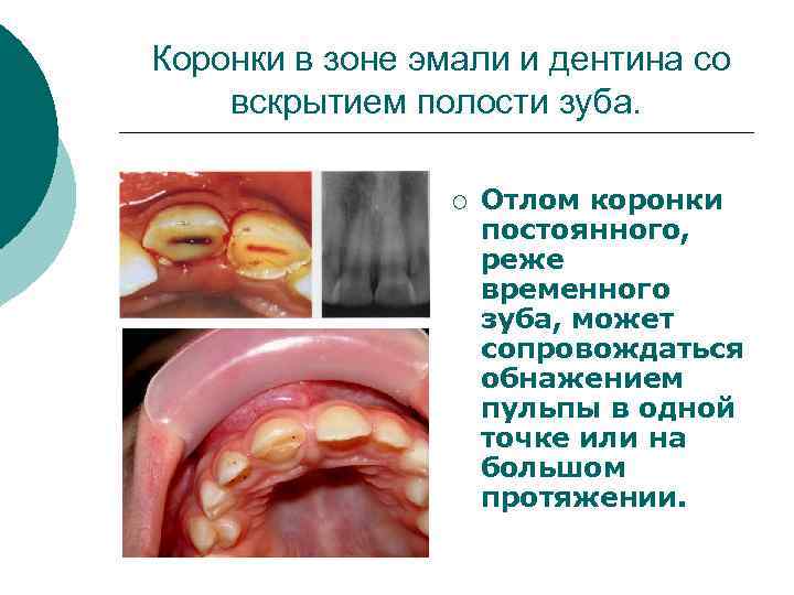 Коронки в зоне эмали и дентина со вскрытием полости зуба. ¡ Отлом коронки постоянного,