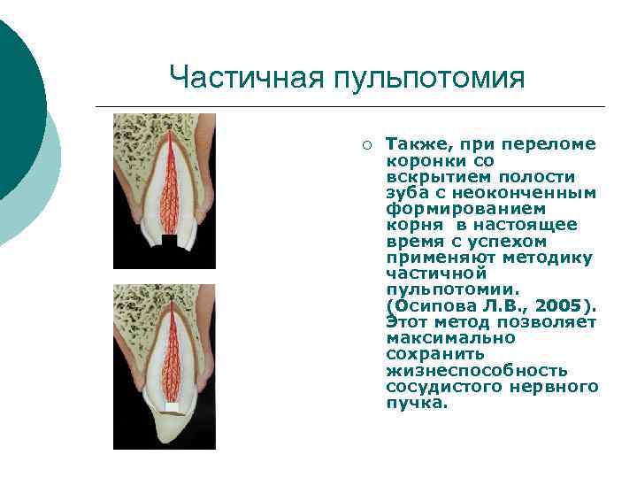 Частичная пульпотомия ¡ Также, при переломе коронки со вскрытием полости зуба с неоконченным формированием