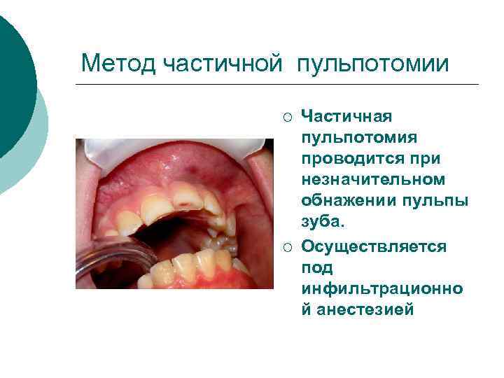 Метод частичной пульпотомии ¡ ¡ Частичная пульпотомия проводится при незначительном обнажении пульпы зуба. Осуществляется