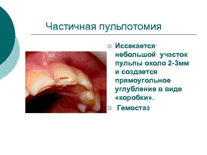 Частичная пульпотомия ¡ ¡ Иссекается небольшой участок пульпы около 2 -3 мм и создается