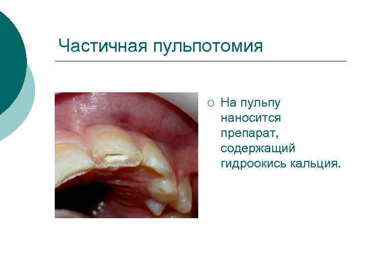 Частичная пульпотомия ¡ На пульпу наносится препарат, содержащий гидроокись кальция. 