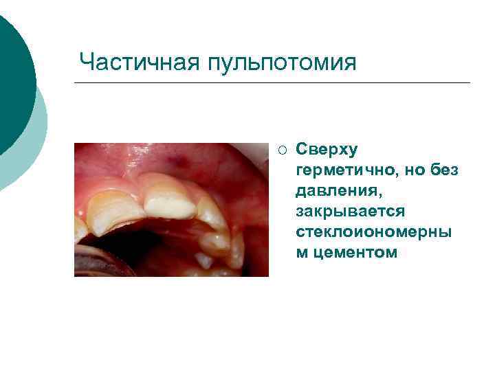 Частичная пульпотомия ¡ Сверху герметично, но без давления, закрывается стеклоиономерны м цементом 