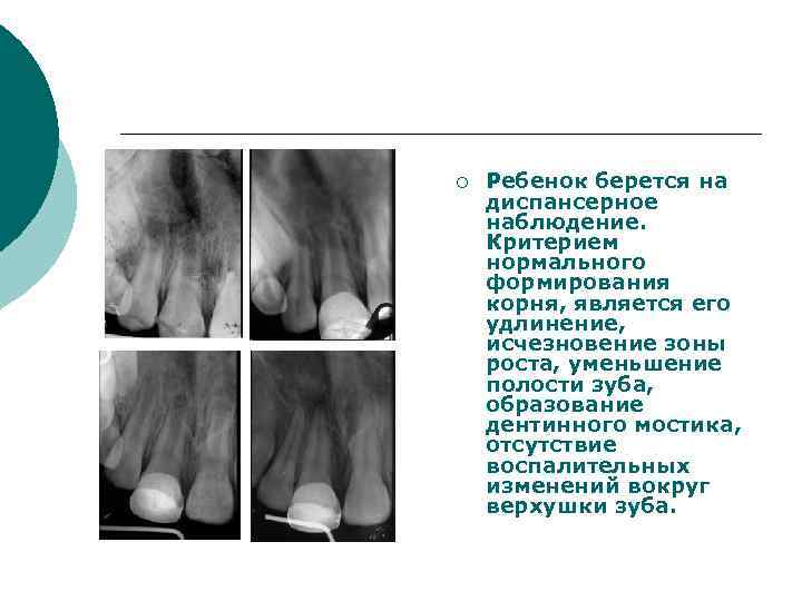 ¡ Ребенок берется на диспансерное наблюдение. Критерием нормального формирования корня, является его удлинение, исчезновение