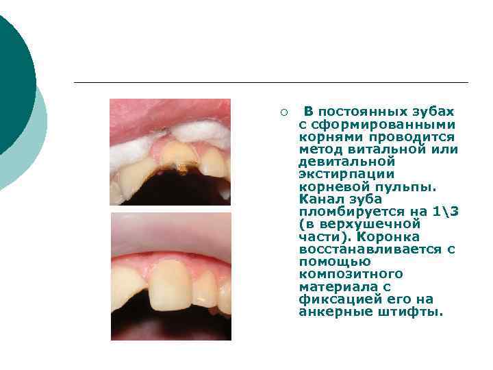 ¡ В постоянных зубах с сформированными корнями проводится метод витальной или девитальной экстирпации корневой