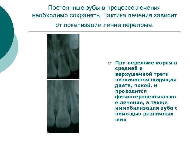 Постоянные зубы в процессе лечения необходимо сохранять. Тактика лечения зависит от локализации линии перелома.