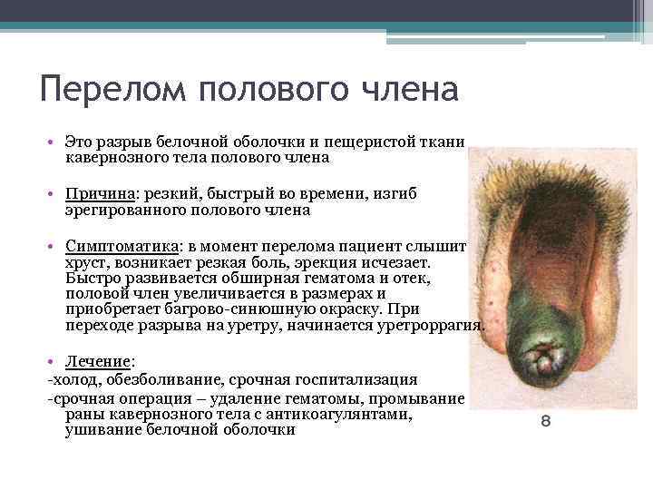 Перелом полового члена • Это разрыв белочной оболочки и пещеристой ткани кавернозного тела полового