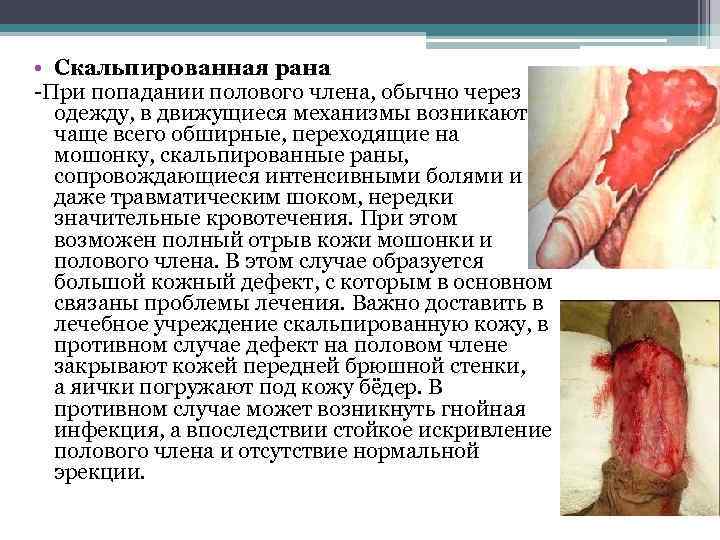  • Скальпированная рана -При попадании полового члена, обычно через одежду, в движущиеся механизмы