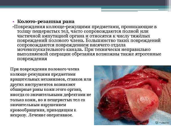  • Колото-резанная рана -Повреждения колюще-режущими предметами, проникающие в толщу пещеристых тел, часто сопровождаются