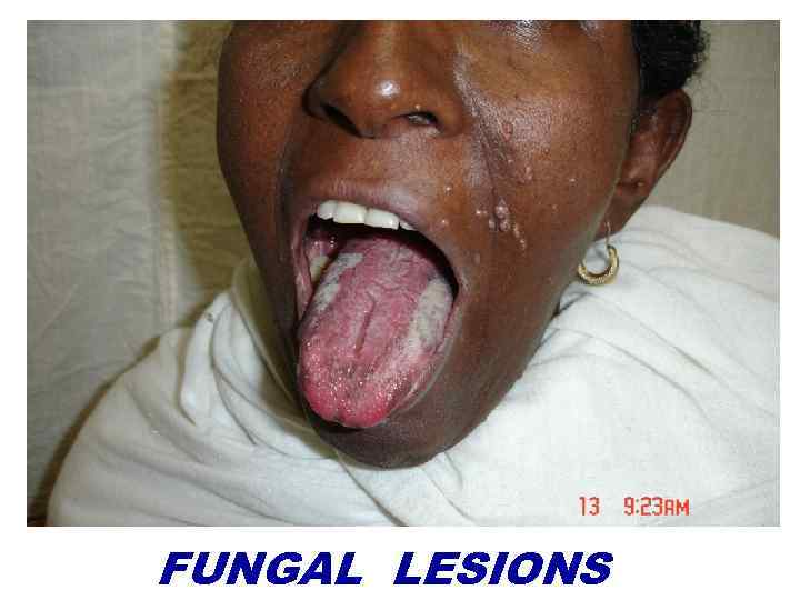 FUNGAL LESIONS 