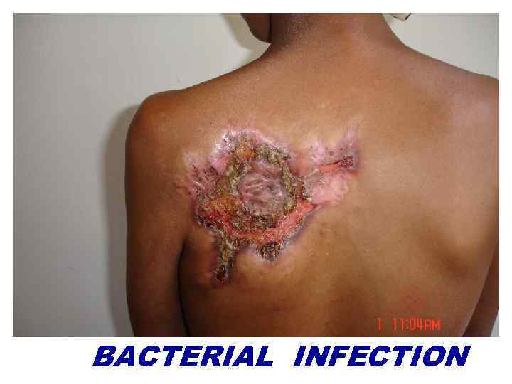 BACTERIAL INFECTION 