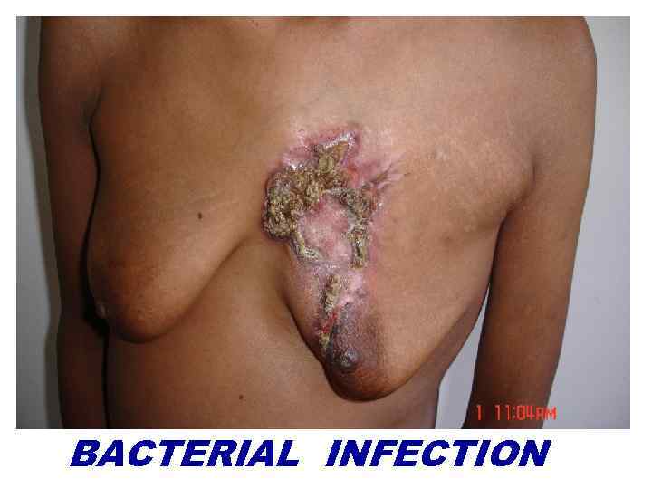 BACTERIAL INFECTION 