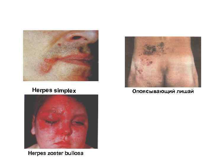 Herpes simplex Herpes zoster bullosa Опоясывающий лишай 