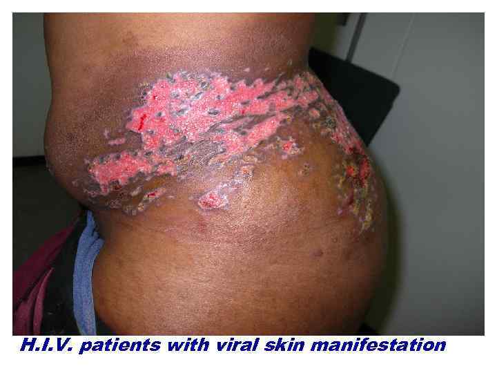 H. I. V. patients with viral skin manifestation 