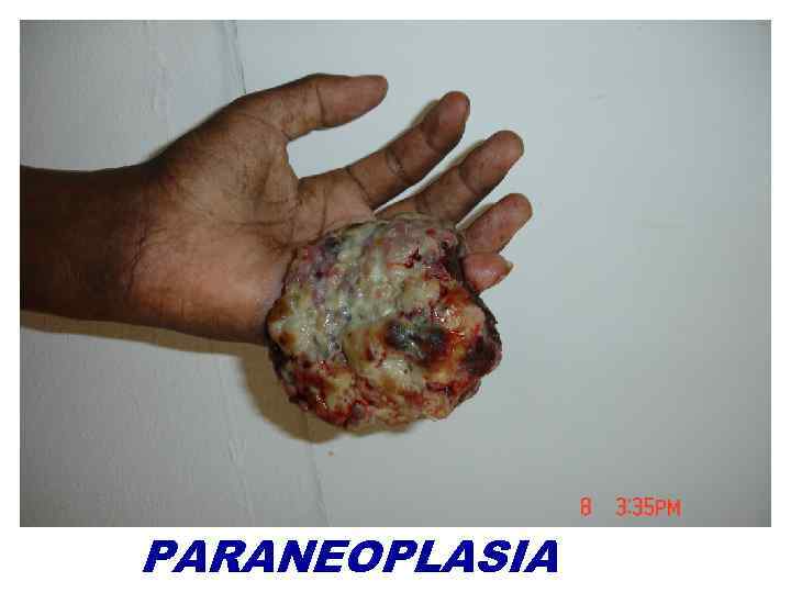 PARANEOPLASIA 