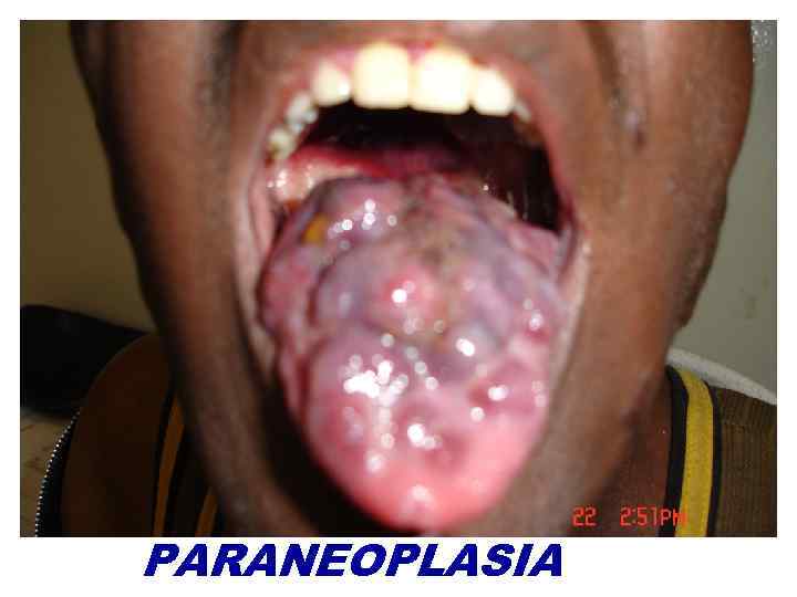 PARANEOPLASIA 