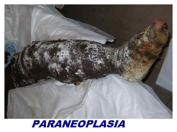 PARANEOPLASIA 