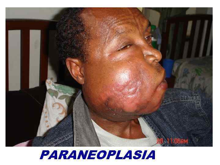 PARANEOPLASIA 