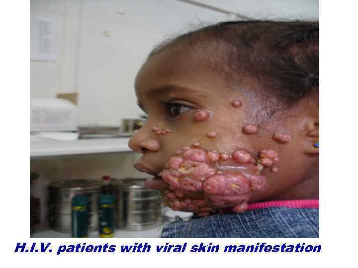 H. I. V. patients with viral skin manifestation 