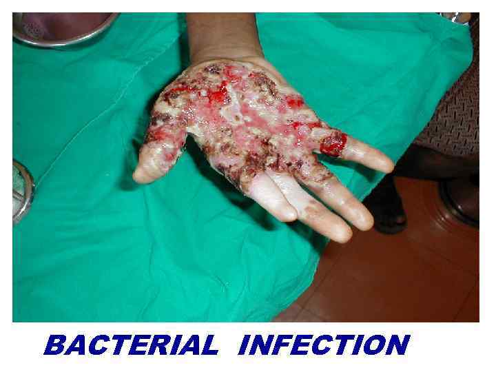 BACTERIAL INFECTION 