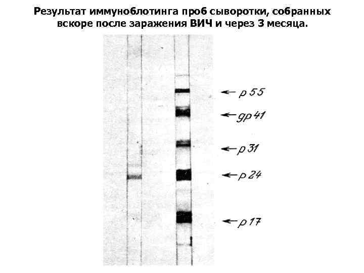 Результат иммуноблотинга проб сыворотки, собранных вскоре после заражения ВИЧ и через 3 месяца. 