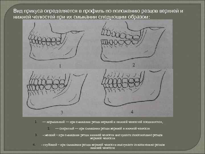 Вид прикуса определяется в профиль по положению резцов верхней и нижней челюстей при их