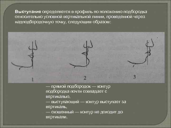 Выступание определяется в профиль по положению подбородка относительно условной вертикальной линии, проведенной через надподбородочную