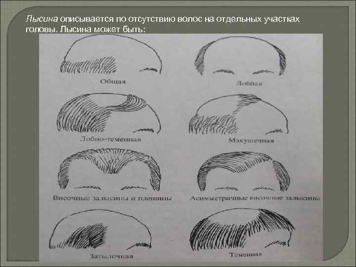 Лысина описывается по отсутствию волос на отдельных участках головы. Лысина может быть: 