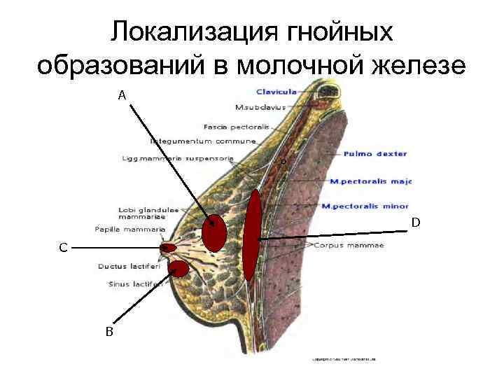 Образование в молочной. Локализация гнойных образований в молочной железе. Образования молочной железы локализуется. Гнойное образование в молочной железе. Болезнь Минца молочной железы.