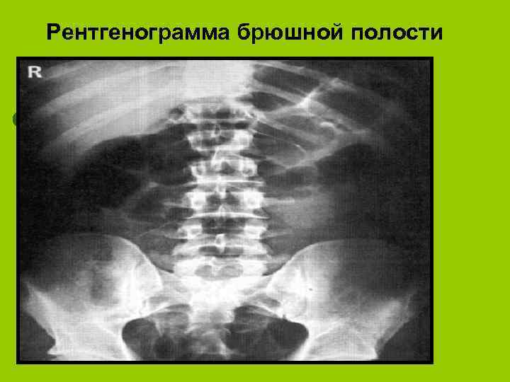 Рентгенограмма брюшной полости 