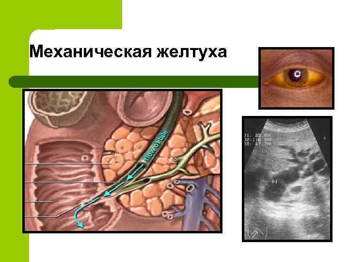 Механическая желтуха 