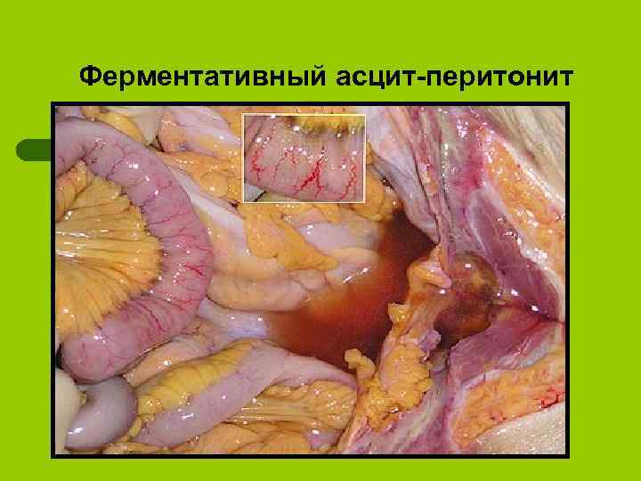 Ферментативный асцит-перитонит 