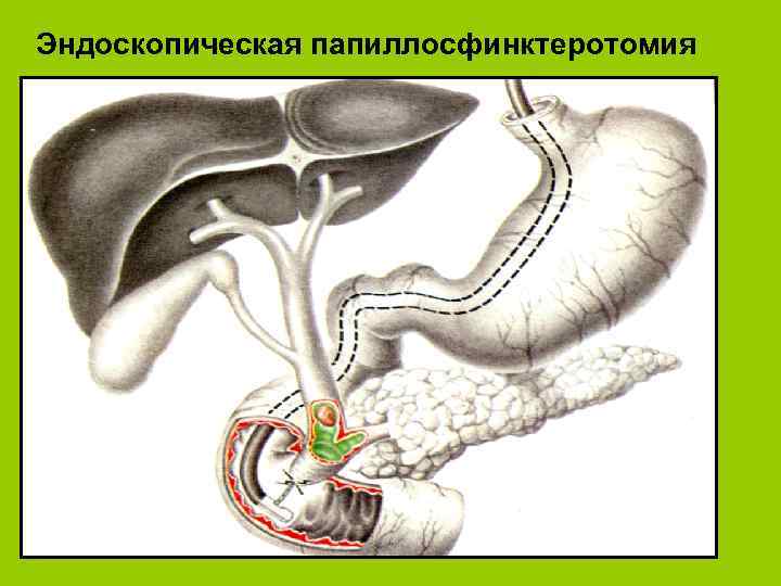 Эндоскопическая папиллосфинктеротомия 