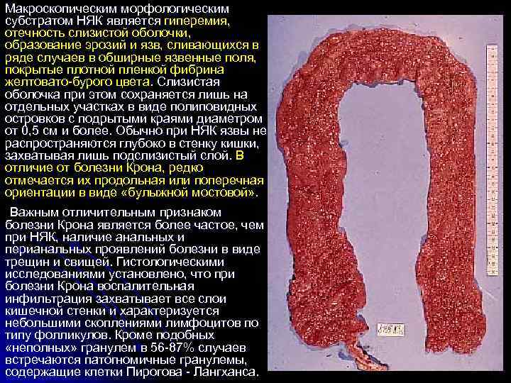 Макроскопическим морфологическим субстратом НЯК является гиперемия, отечность слизистой оболочки, образование эрозий и язв, сливающихся