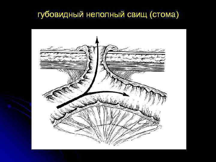 губовидный неполный свищ (стома) 