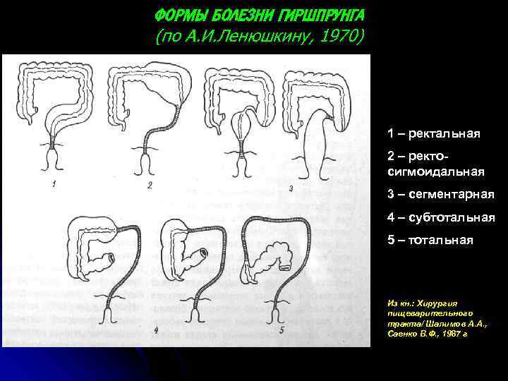 ФОРМЫ БОЛЕЗНИ ГИРШПРУНГА (по А. И. Ленюшкину, 1970) 1 – ректальная 2 – ректосигмоидальная