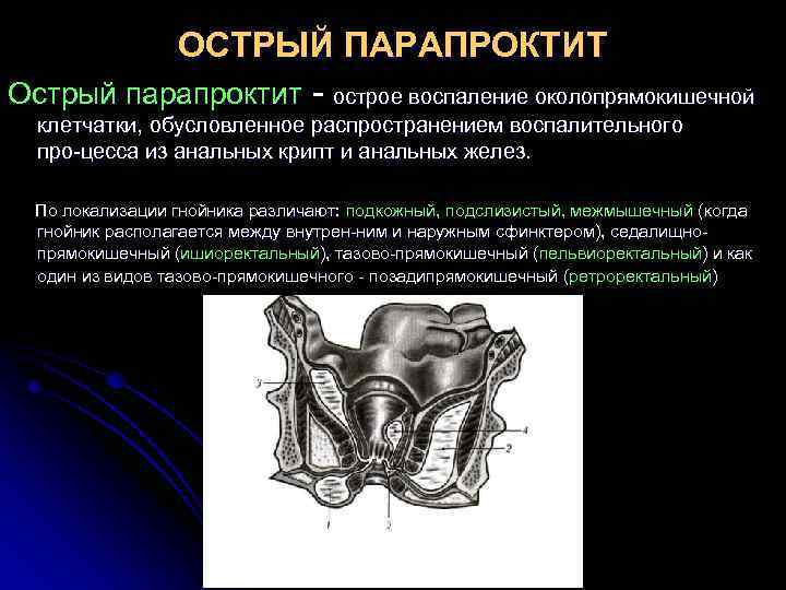 ОСТРЫЙ ПАРАПРОКТИТ Острый парапроктит острое воспаление околопрямокишечной клетчатки, обусловленное распространением воспалительного про цесса из