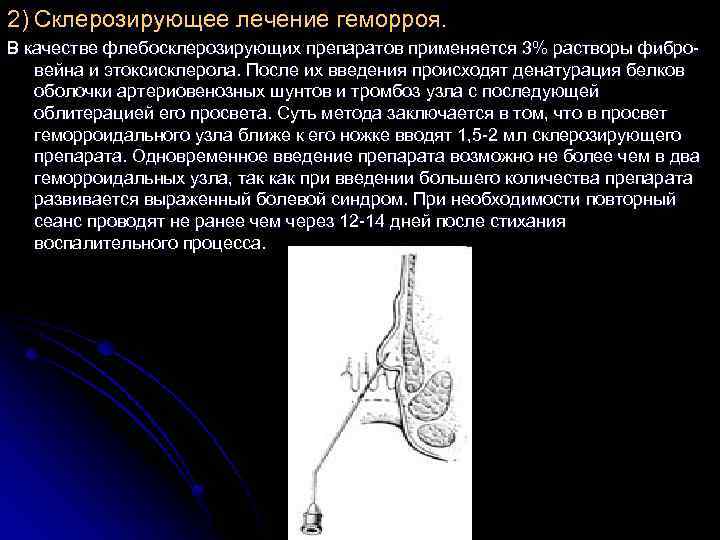 2) Склерозирующее лечение геморроя. В качестве флебосклерозирующих препаратов применяется 3% растворы фибро вейна и