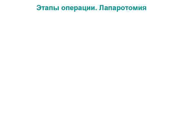 Этапы операции. Лапаротомия 