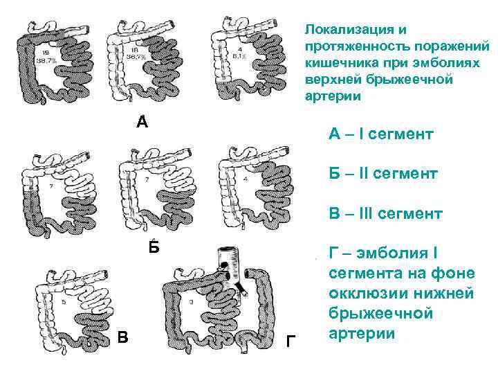 Локализация и протяженность поражений кишечника при эмболиях верхней брыжеечной артерии А А – I