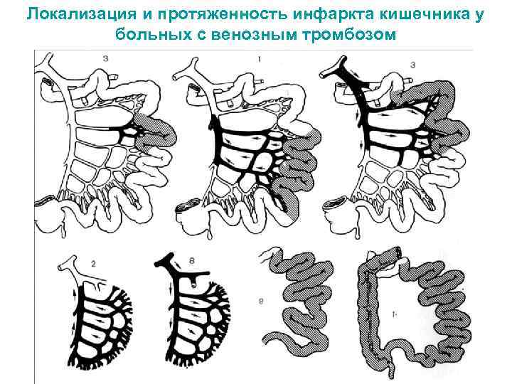 Локализация и протяженность инфаркта кишечника у больных с венозным тромбозом 