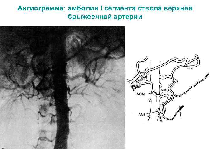 Ангиограмма: эмболии I сегмента ствола верхней брыжеечной артерии 