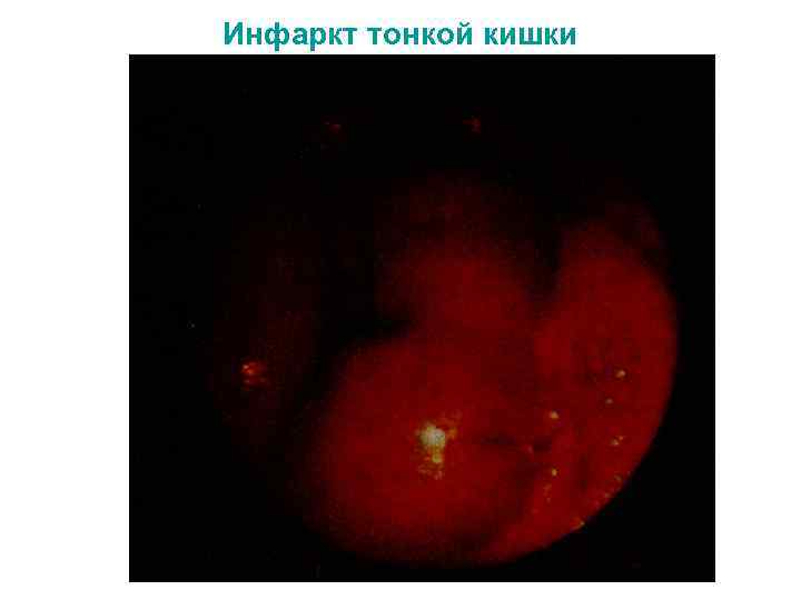 Инфаркт тонкой кишки 