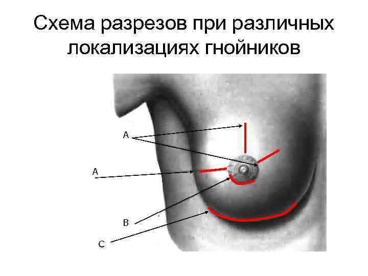 Схема разрезов при различных локализациях гнойников А А В С 