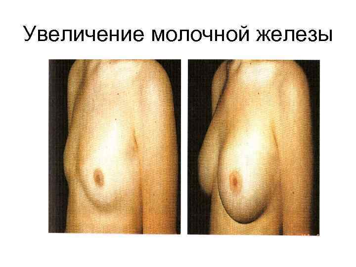 Увеличение молочной железы 