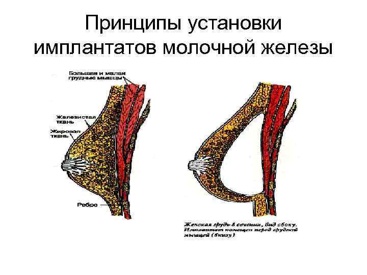 Принципы установки имплантатов молочной железы 